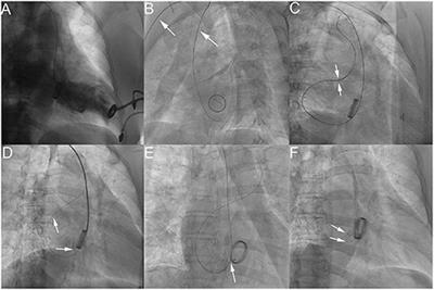 Transbrachial Access for Transcatheter Closure of Paravalvular Leak Following Prosthetic Valve Replacement